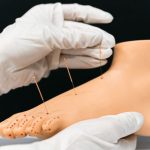 tips belajar akupuntur